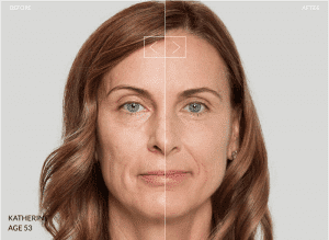 Unlock Your Natural Beauty with Sculptra® at AION Aesthetics
