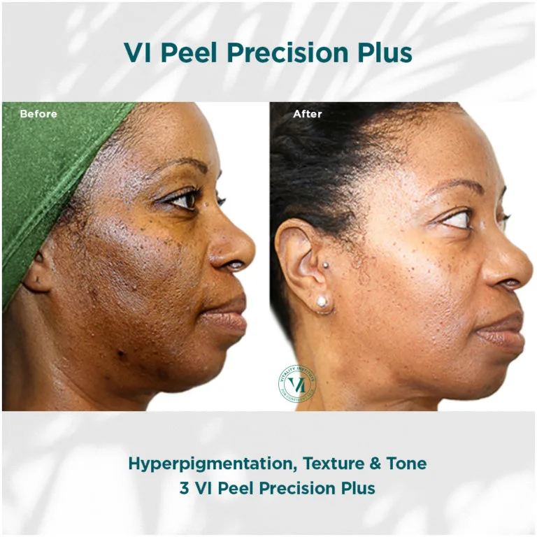 VI Peel