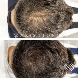 The results of PRP for thinning hair in New York City