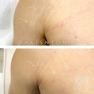 The prominent results of a salmon DNA facial in New York City.