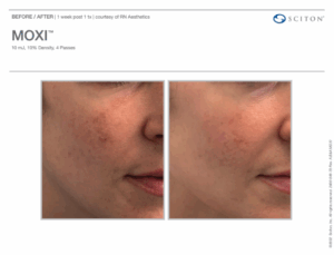 The before and after photos of a patient who has received laser resurfacing in New York City for unwanted pigmentation.