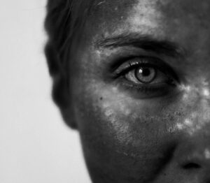 A close-up of a woman's face after a VI Peel, an alternative to melasma treatment in Upper East Side, NYC.